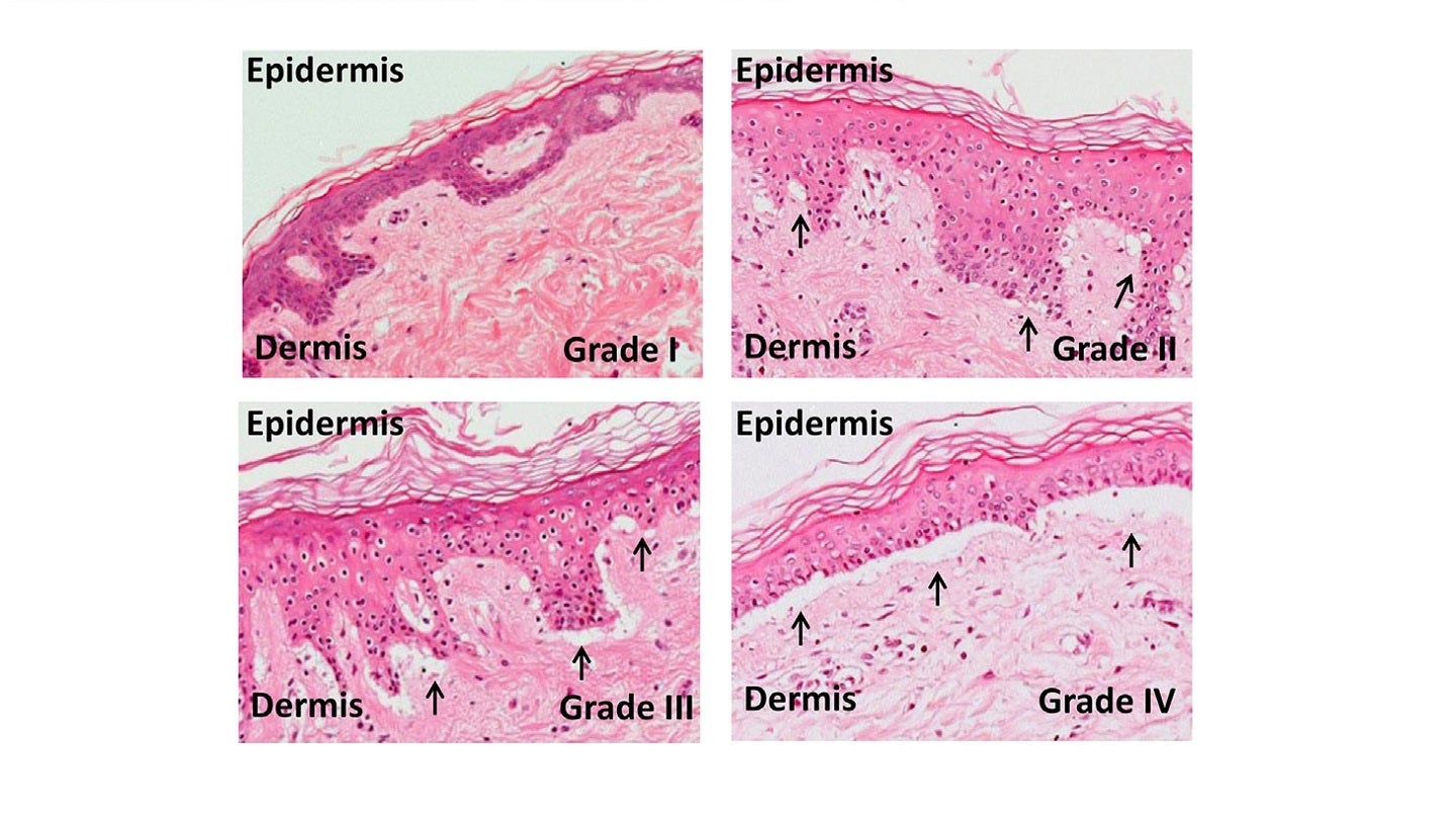 CIRM grants funds to Ossium Health for OSSM-007 development