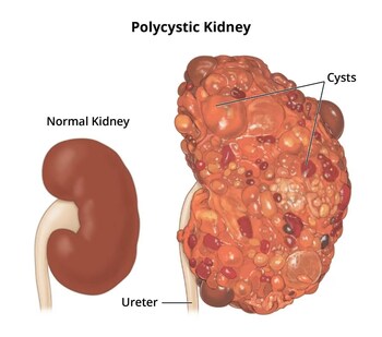 PYC'S FOURTH DRUG CANDIDATE HAS DISEASE-MODIFYING POTENTIAL IN POLYCYSTIC KIDNEY DISEASE