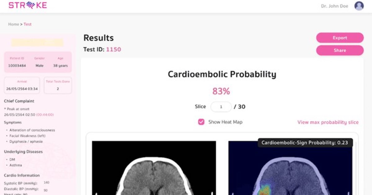 Roundup: Thai researchers develop AI for assessing stroke risk and more briefs