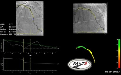 Pie Medical Imaging announces 500th patient in the FAST III clinical trial