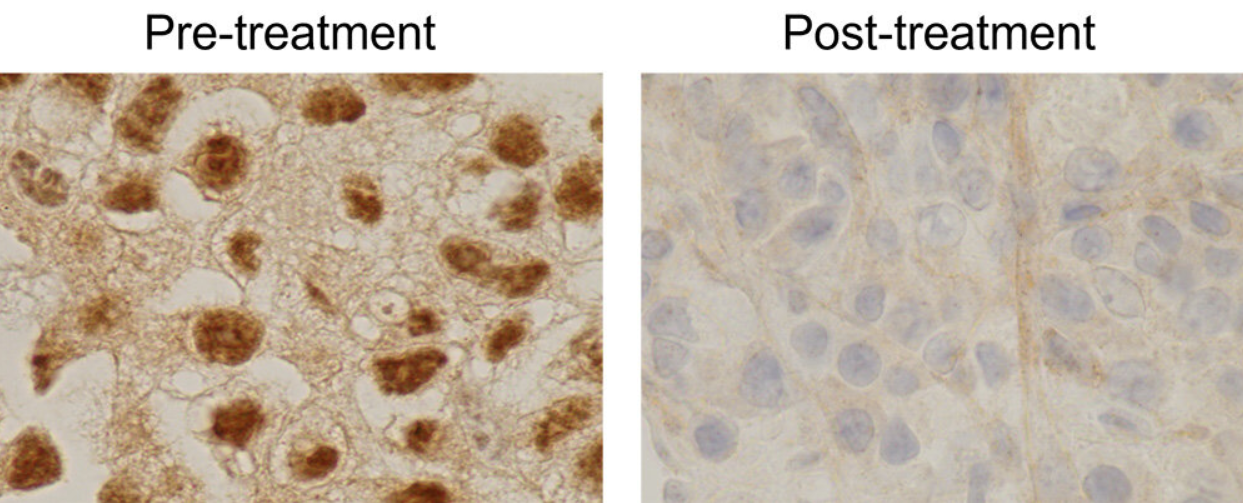 Clin Cancer Res & JCO：一种新型的基于RNA的疗法或有望治疗对靶向药物耐受的人类肾脏癌症