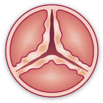 Heart-Valve-Surgery.Com and Medtronic Launch Novel "Aortic Stenosis Patient Activation Platform" to Empower Patients