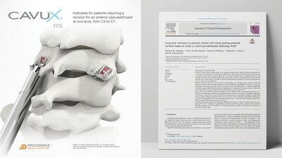 Providence Medical Technology Announces New Publication Demonstrating High Fusion Rates and Successful Outcomes in Previously Failed Cervical Fusion Patients