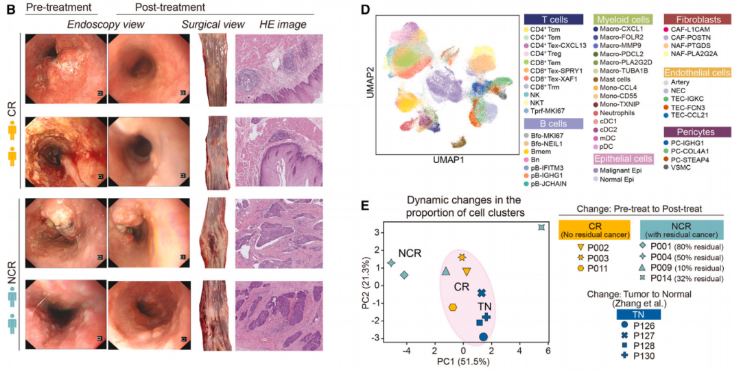 《癌细胞》：中国科学家找到食管癌新辅助免疫预后风向标！