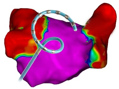 Biosense Webster Announces Regulatory Approval of VARIPULSE™ Pulsed Field Ablation (PFA) Platform in Japan