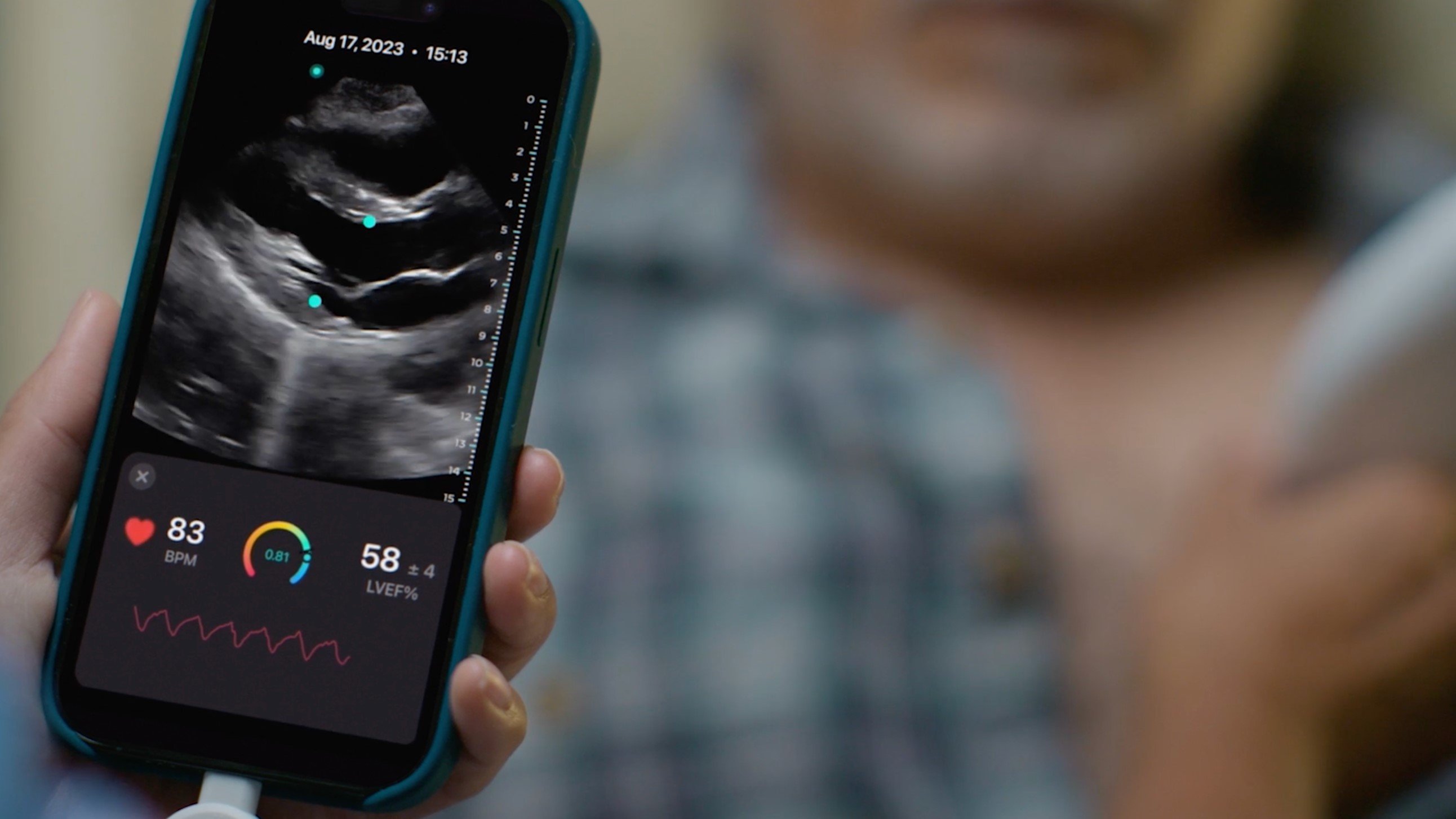 Exo brings AI heart, lung apps to its hand-held ultrasound probe