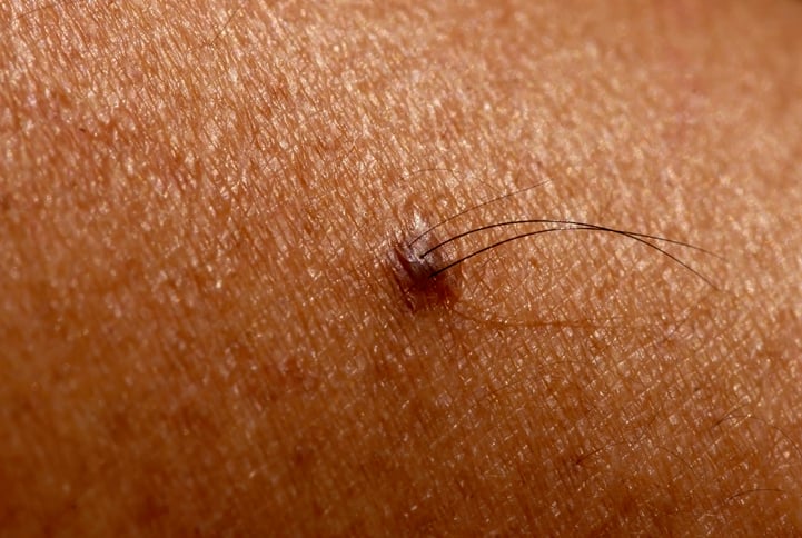 The culprit behind hairy moles could treat pattern baldness