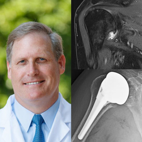 Catalyst OrthoScience Announces First Series of Procedures Using World’s Only Fully Convertible Stemmed CSR TSA System Featuring an Ellipsoid Humeral Head