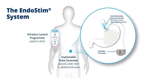 EndoStim Concludes Pre-Submission Meeting with the FDA and Prepares Submission for Premarket Approval of the EndoStim System for the Treatment of Drug Refractory GERD