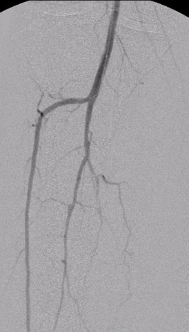 Injectable Angioplasty Balloon Catheter Transforms Peripheral Procedures, Users Report Reduced Equipment and Contrast Needs