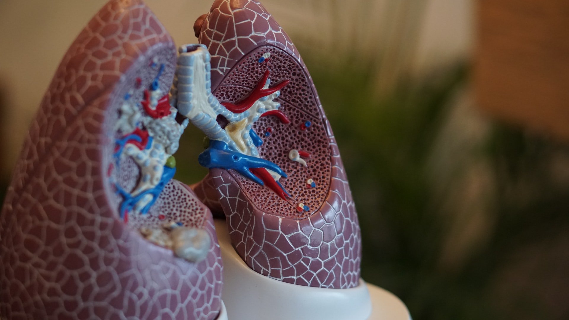 Vicore's bet pays off as pulmonary fibrosis drug improves lung function in phase 2