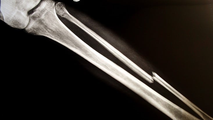 Ultragenyx-Mereo's brittle bone drug sustains fracture rate cut in midphase follow-up