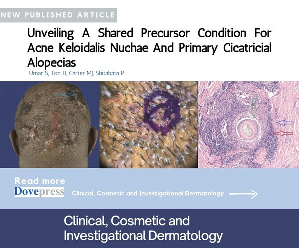 New Study Uncovers Shared Precursor Condition for Acne Keloidalis Nuchae and Primary Cicatricial Alopecias