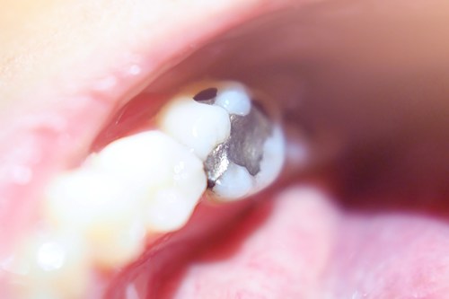 Mercury Released from Dental Amalgam Fillings in Response to Different Physical Stressors