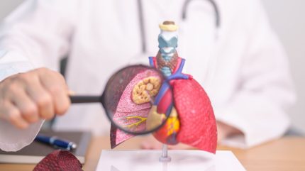 FDA issues complete response to Daiichi Sankyo-MSD’s BLA for NSCLC