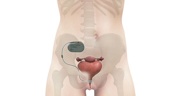 UroMems Announces First-Ever Smart Artificial Urinary Sphincter Implant in a Female Patient